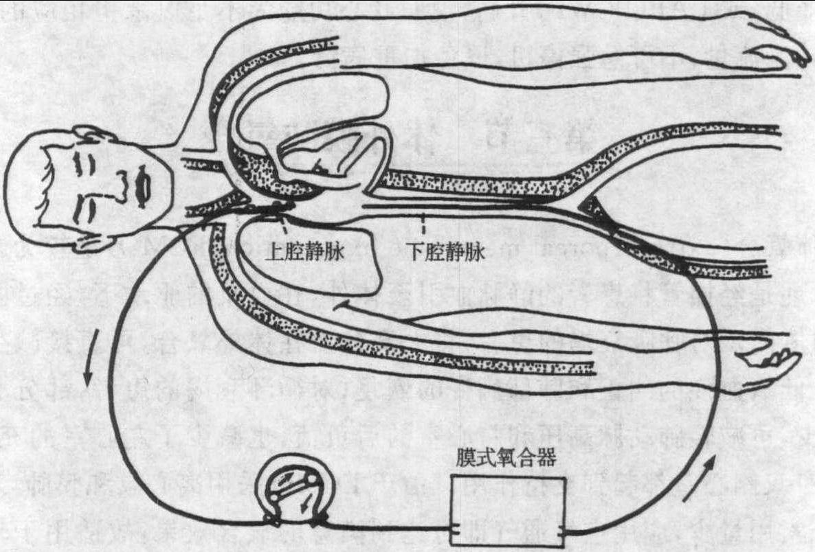 第三節(jié) 體外膜肺氧合